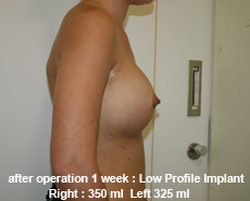 plastic-surgery-breast-augmentation